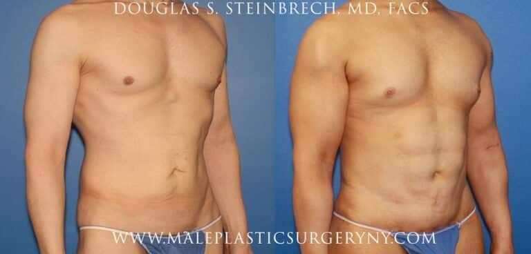 Body lift for sculpting the torso by Dr. Steinbrech