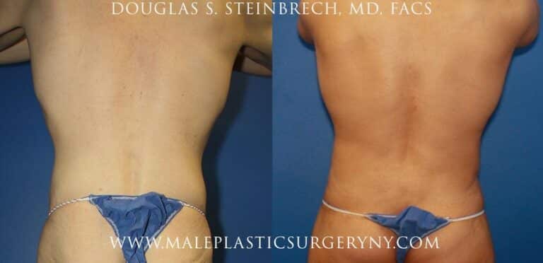Body lift for sculpting the torso by Dr. Steinbrech