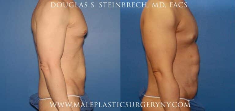 Body lift for sculpting the torso by Dr. Steinbrech