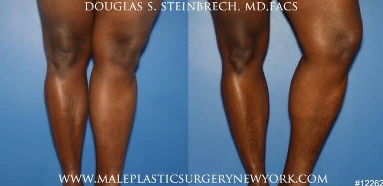 Calf augmentation using implants by Dr. Steinbrech