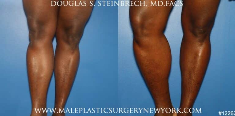 Calf augmentation using implants by Dr. Steinbrech