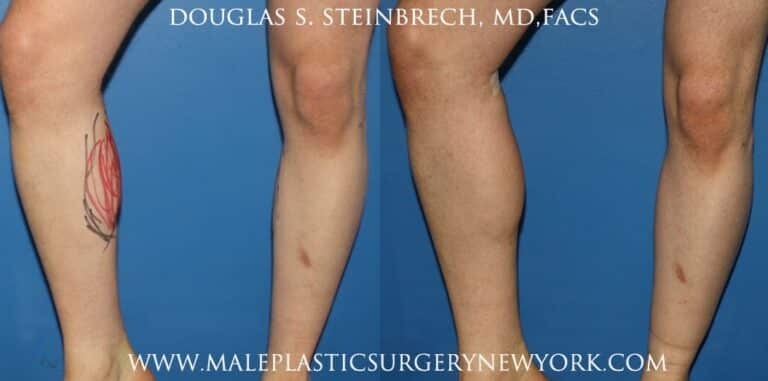 Calf augmentation with implants by Dr. Steinbrech