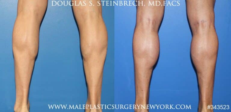 Calf implants to augment the lower leg by Dr. Steinbrech