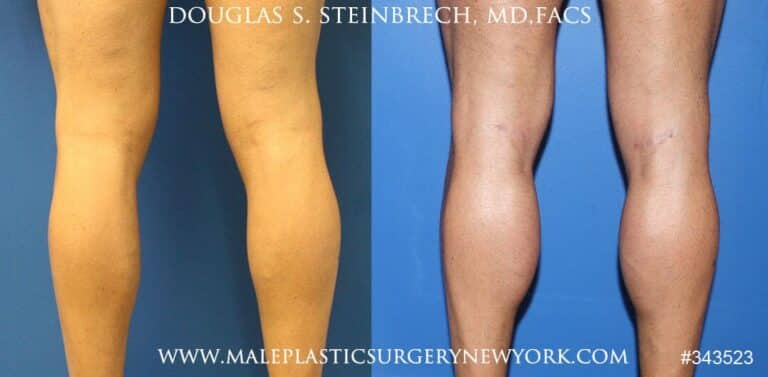 Calf implants to augment the lower leg by Dr. Steinbrech