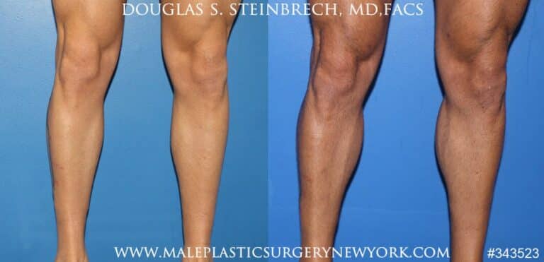 Calf implants to augment the lower leg by Dr. Steinbrech