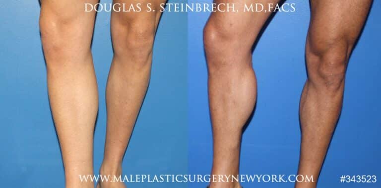 Calf implants to augment the lower leg by Dr. Steinbrech