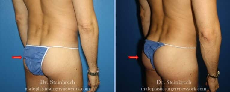 Daddy do over for body contouring by Dr. Steinbrech