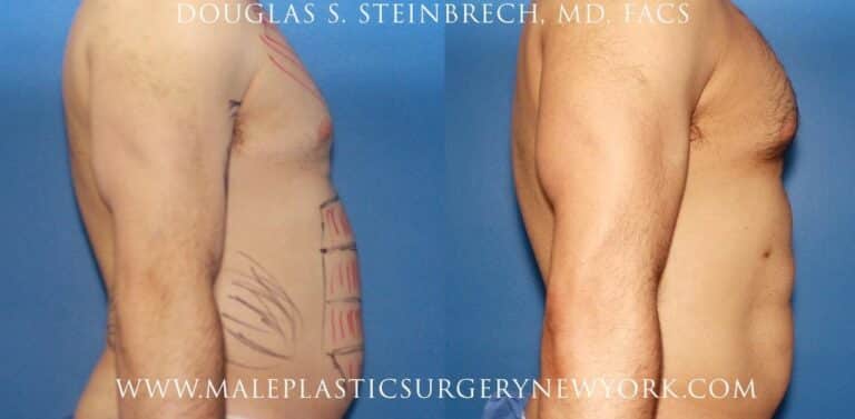 Gladiator abs and body banking for bicep augmentation by Dr. Steinbrech
