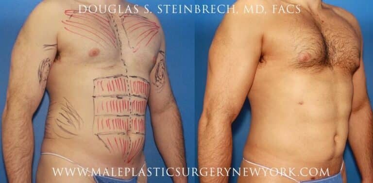 Gladiator abs and body banking for bicep augmentation by Dr. Steinbrech
