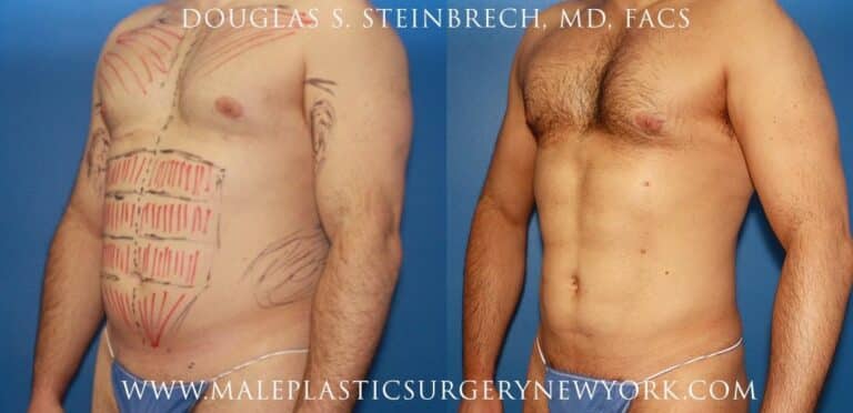 Gladiator abs and body banking for bicep augmentation by Dr. Steinbrech