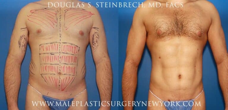 Gladiator abs and body banking for bicep augmentation by Dr. Steinbrech