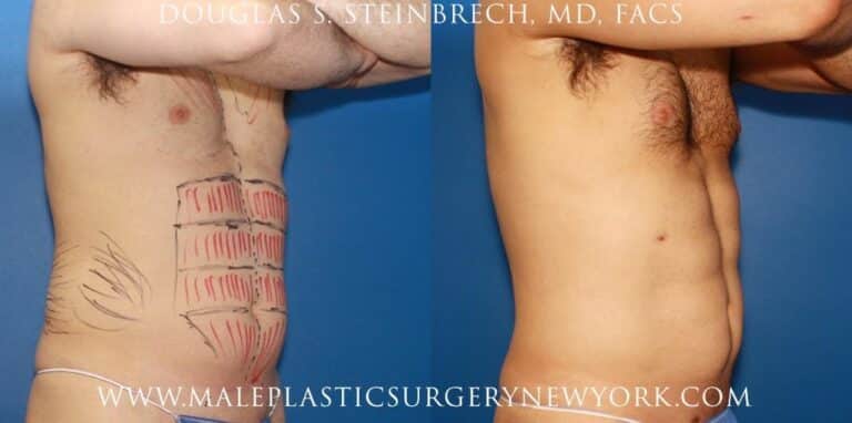 Gladiator abs for body contouring by Dr. Steinbrech