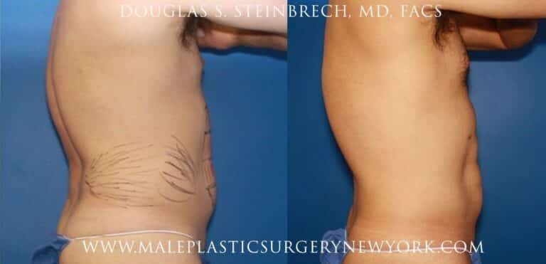 Gladiator abs for body contouring by Dr. Steinbrech