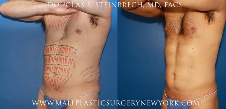 Gladiator abs for body contouring by Dr. Steinbrech