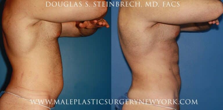 Gladiator abs for body sculpting by Dr. Steinbrech