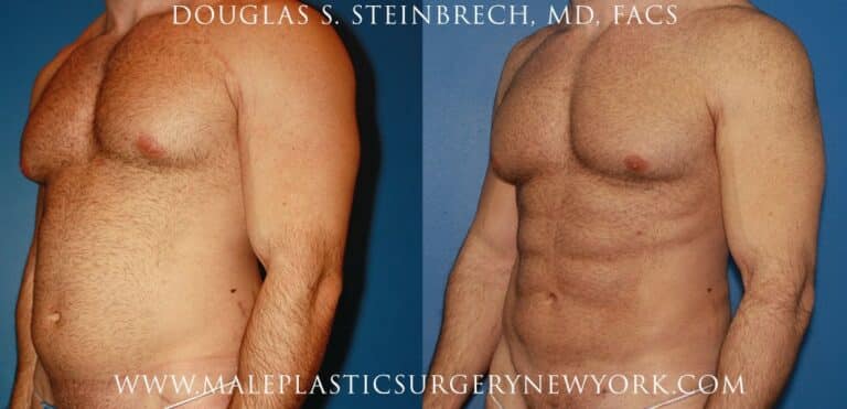 Gladiator abs for body sculpting by Dr. Steinbrech