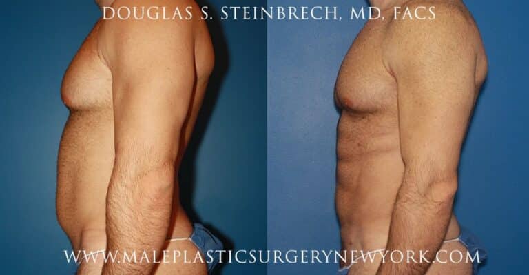 Gladiator abs for body sculpting by Dr. Steinbrech