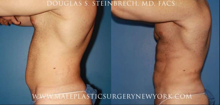 Gladiator abs for body sculpting by Dr. Steinbrech
