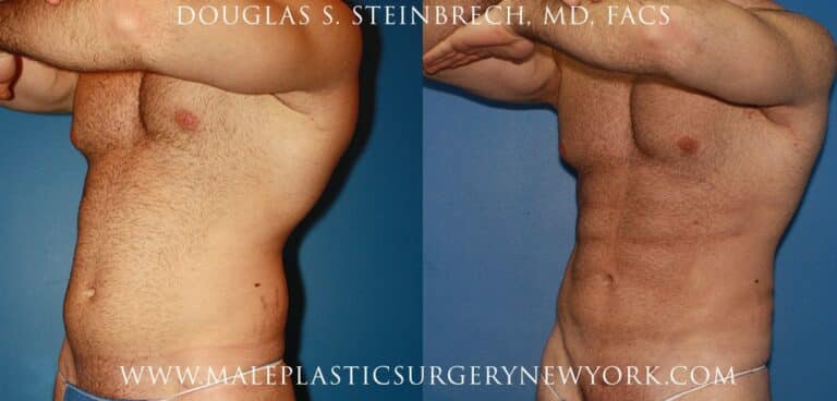 Gladiator abs for body sculpting by Dr. Steinbrech
