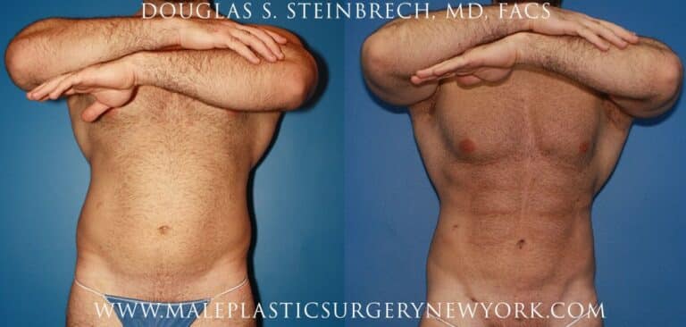 Gladiator abs for body sculpting by Dr. Steinbrech
