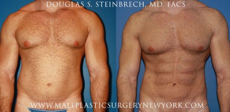 Gladiator abs for body sculpting by Dr. Steinbrech