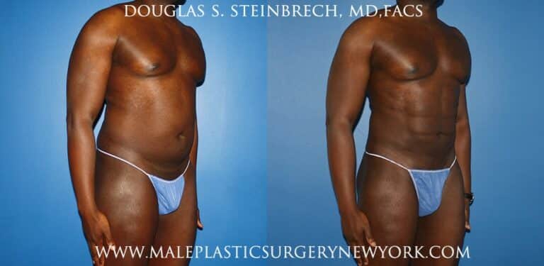 Gladiator abs and quarterback buttock lift by Dr. Steinbrech