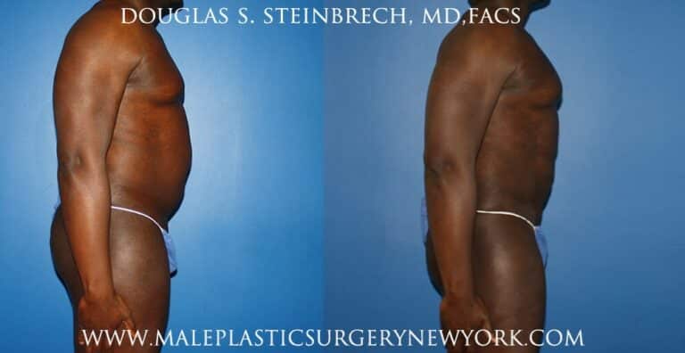 Gladiator abs and quarterback buttock lift by Dr. Steinbrech
