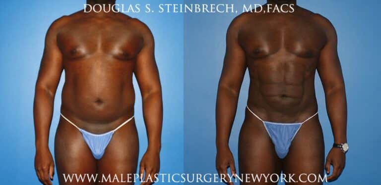 Gladiator abs and quarterback buttock lift by Dr. Steinbrech