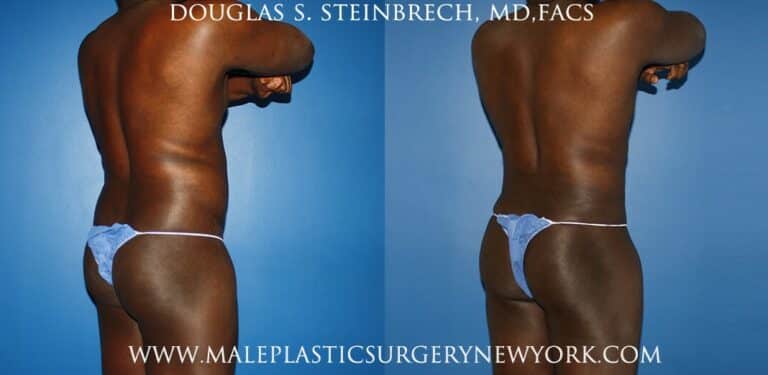 Gladiator abs and quarterback buttock lift by Dr. Steinbrech