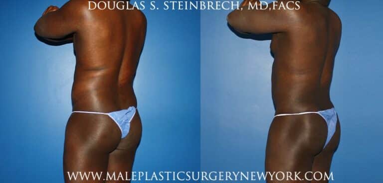 Gladiator abs and quarterback buttock lift by Dr. Steinbrech