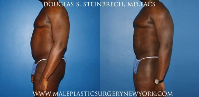 Gladiator abs and quarterback buttock lift by Dr. Steinbrech