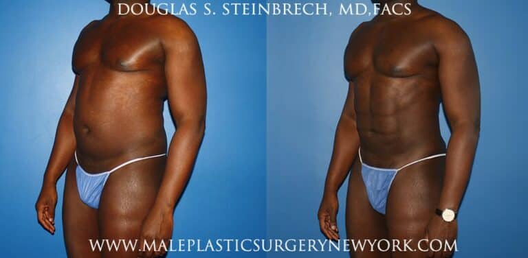 Gladiator abs and quarterback buttock lift by Dr. Steinbrech