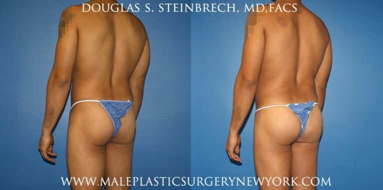 Gluteal augmentation with implants and body banking by Dr. Steinbrech