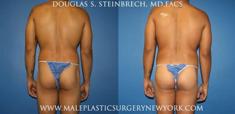 Gluteal augmentation with implants and body banking by Dr. Steinbrech