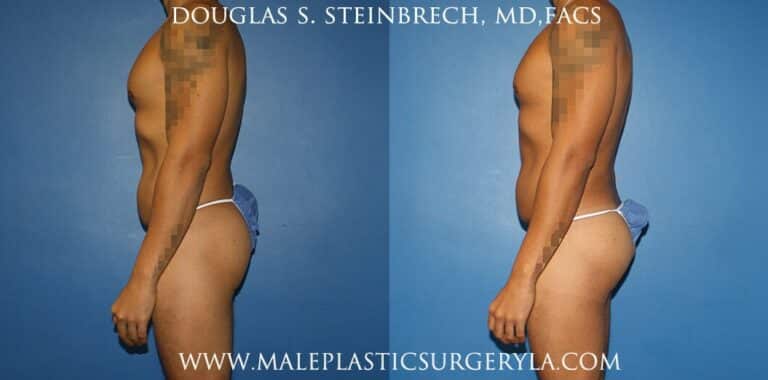 Gluteal augmentation with implants and body banking by Dr. Steinbrech