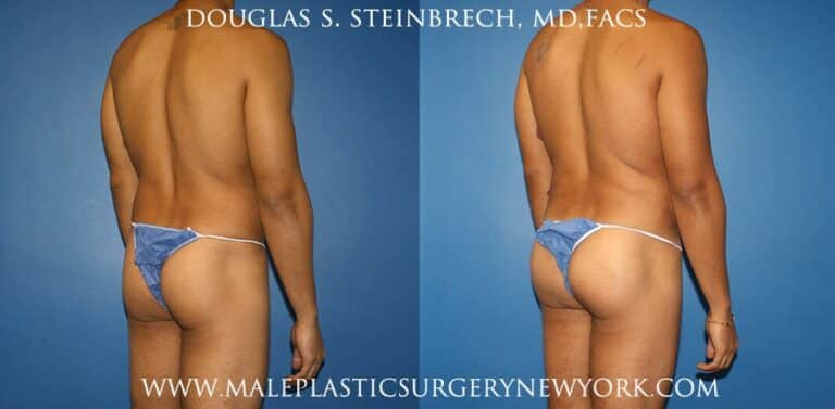 Gluteal augmentation with implants and body banking by Dr. Steinbrech