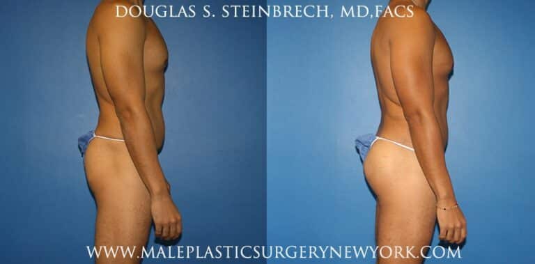 Gluteal augmentation with implants and body banking by Dr. Steinbrech