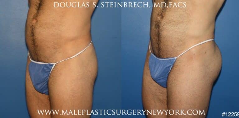 Gluteal augmentation to enhance the buttocks by Dr. Steinbrech