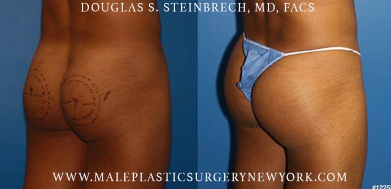 Gluteal augmentation to shape the buttocks by Dr. Steinbrech