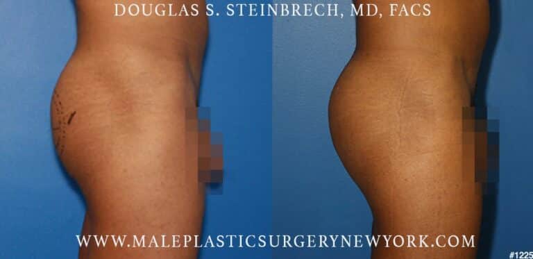 Gluteal augmentation to shape the buttocks by Dr. Steinbrech