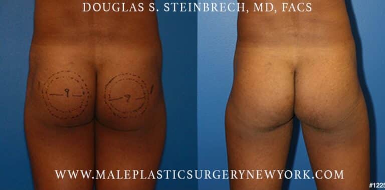 Gluteal augmentation to shape the buttocks by Dr. Steinbrech