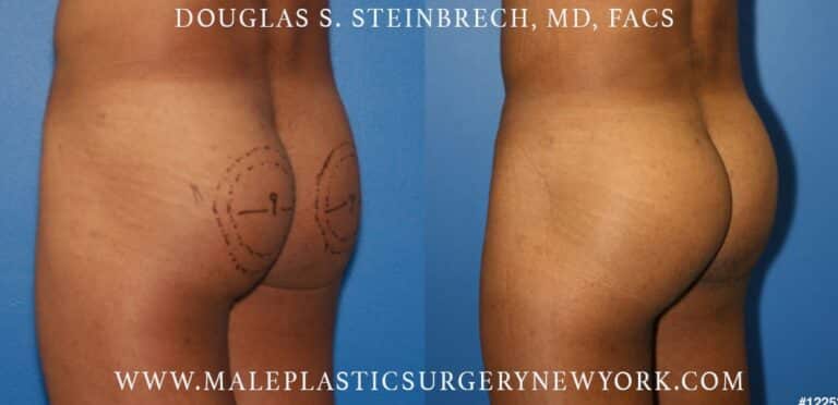 Gluteal augmentation to shape the buttocks by Dr. Steinbrech