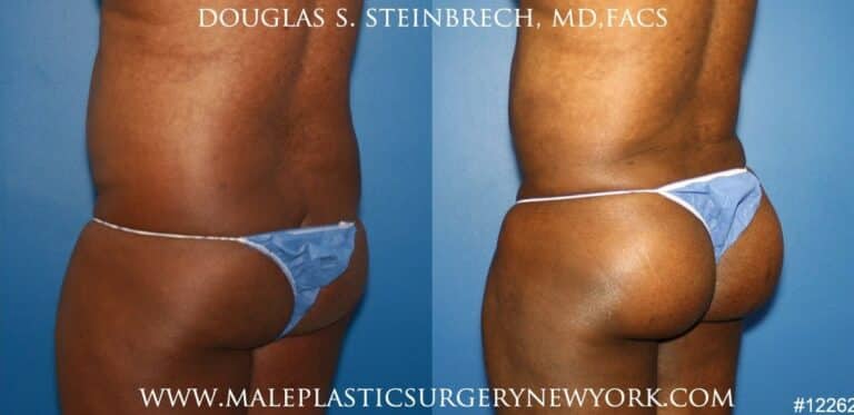 Gluteal augmentation for rounder buttocks by Dr. Steinbrech