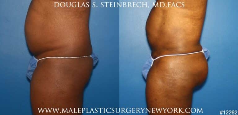 Gluteal augmentation for rounder buttocks by Dr. Steinbrech