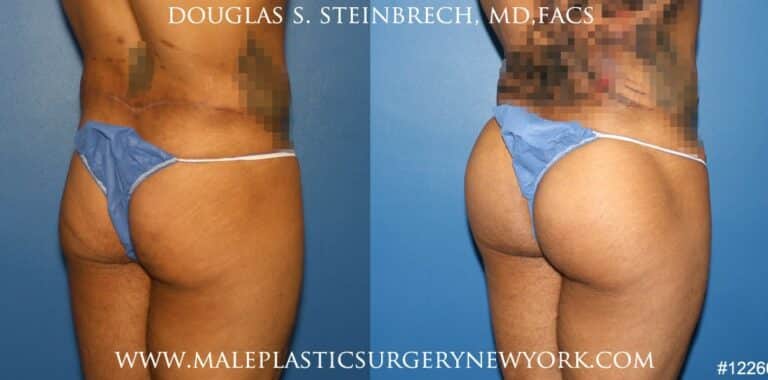 Gluteal augmentation for buttock shaping by Dr. Steinbrech