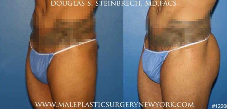 Gluteal augmentation for buttock shaping by Dr. Steinbrech