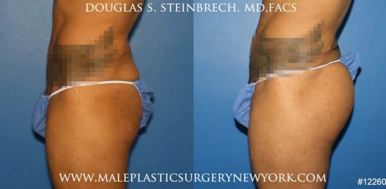 Gluteal augmentation for buttock shaping by Dr. Steinbrech