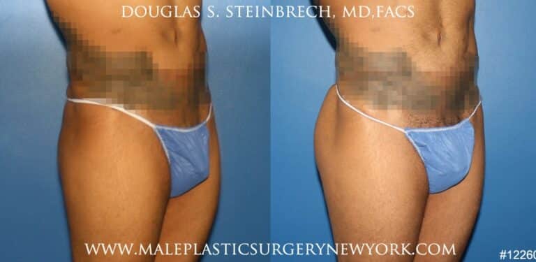 Gluteal augmentation for buttock shaping by Dr. Steinbrech