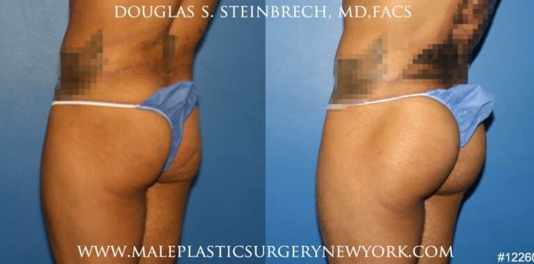 Gluteal augmentation for buttock shaping by Dr. Steinbrech