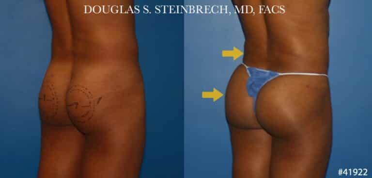 Gluteal augmentation revision to enhance the buttocks by Dr. Steinbrech
